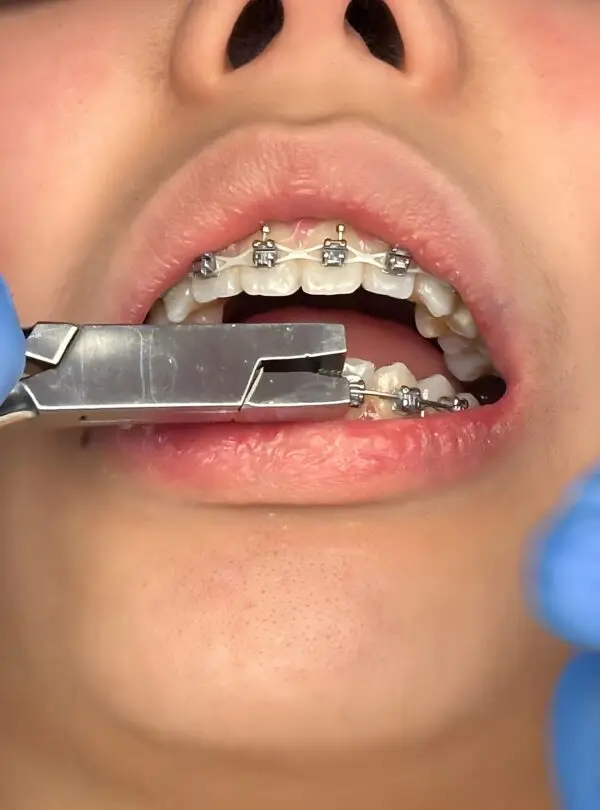 Orthodontist treatment installing braces system on a teen.